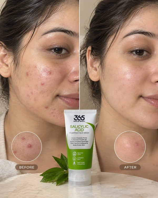 Salicylic Acid Face Wash – Acne Control & Excess Oil