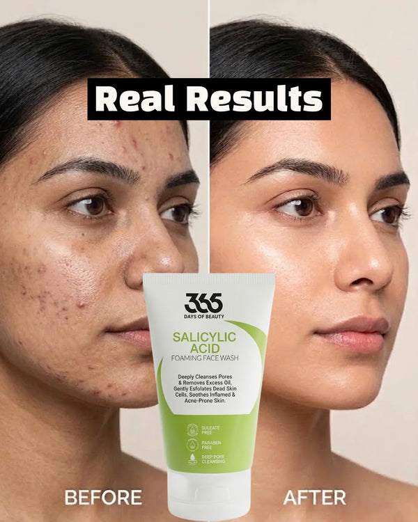 Salicylic Acid Face Wash – Acne Control & Excess Oil